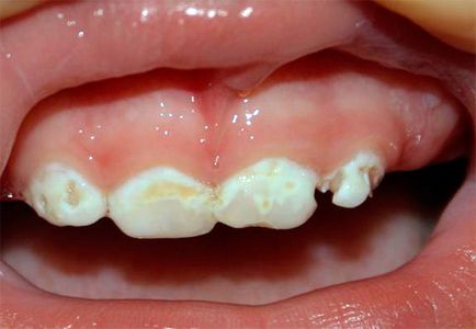 Cariile dinților din lapte reprezintă o problemă care trebuie abordată imediat