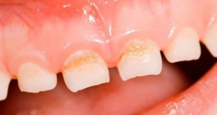 Карієс молочних зубів проблема, яка потребує невідкладного вирішення