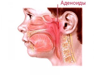 Кашель при аденоїдах як провести лікування