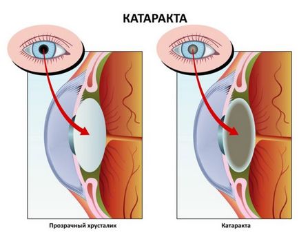 Катаракта очі що це таке, причини, симптоми, лікування