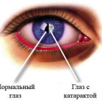 Катаракта - Симптоми и признаци