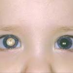 Cataracta - simptome și semne