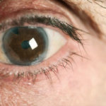 Cataracta - simptome și semne