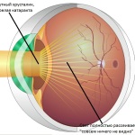 Катаракта - симптоми і ознаки