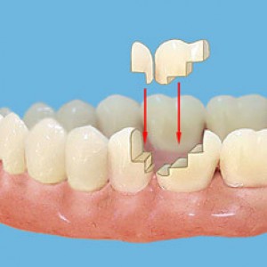 Inserția ceramică păstrează dentura de ameliorare a dinților