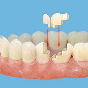 Керамічна вкладка збереже зруйнований дощенту зуб - Меліора дент