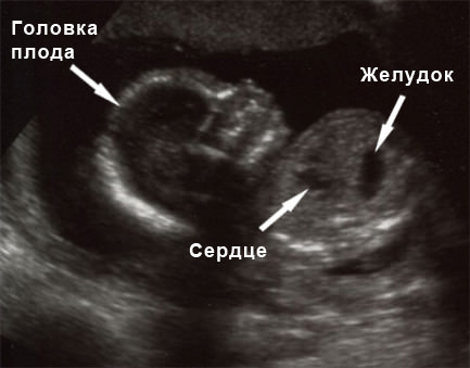 Malformații pulmonare adenomatoase maligne