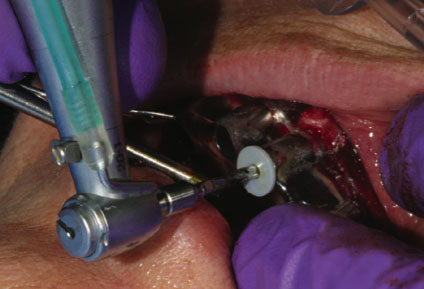 Modelare și implantare a dinților, implantarea dinților, stadii de instalare, stomatologie