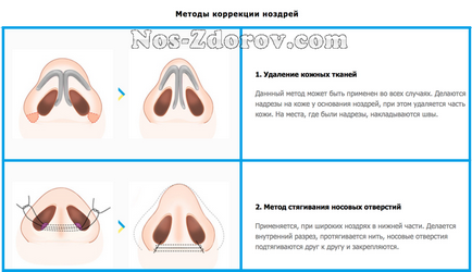 Corectarea aripilor nasului înainte și după fotografie, video, recenzii