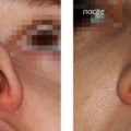 Corectarea aripilor nasului înainte și după fotografie, video, recenzii