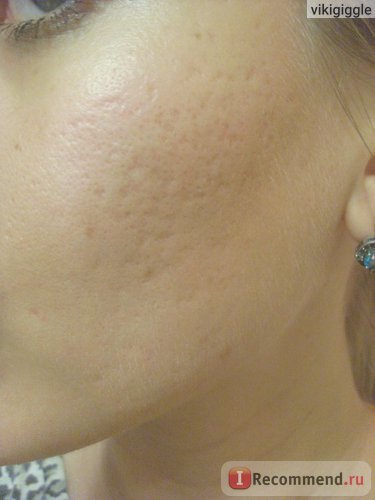 Kozmetikai eljárások mechanikai tisztítás arc - „a szomorú történet, hogy hogyan én eltorzult arc