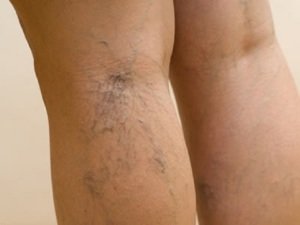 Crema din asteriscurile vasculare de pe picioare, care crema îndepărtează cel mai bine asteriscurile