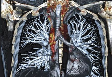 CT a organelor toracice - care arată un record al studiului