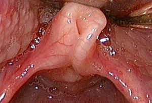 Laryngomalacia - centrul medicului ari diro