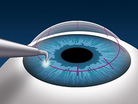 Tratamentul glaucomului în Germania