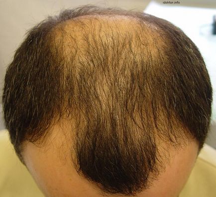 Tratamentul alopeciei prin metode Ayurveda - articole de ayurveda din India, chavanprash, sanatate