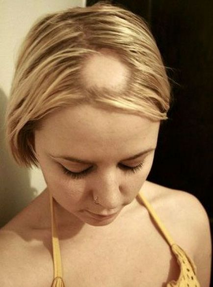 Tratamentul alopeciei prin metode Ayurveda - articole de ayurveda din India, chavanprash, sanatate