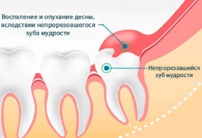 Tratamentul pericoronitei (excizia capotei dintelui de înțelepciune)