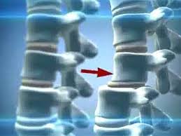 Coloana vertebrală a coloanei vertebrale și tratamentul, coloana vertebrală