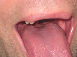 Macroglossia (creșterea limbii) cauze, simptome, tratament, efecte