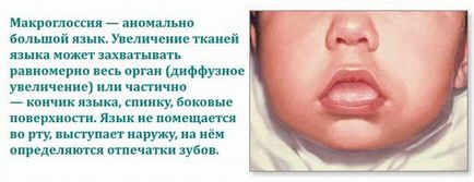 Macroglossia (creșterea limbii) cauze, simptome, tratament, efecte