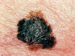 Melanomul - tratament, simptome, semne