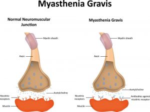 Myasthenia gravis, fizioterapie