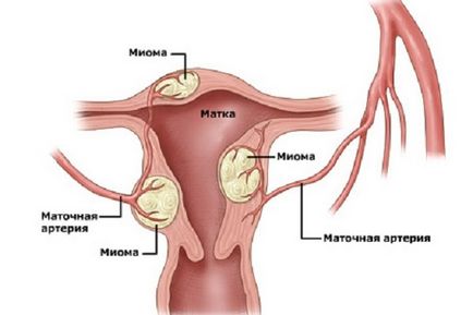 Міома матки онкологія