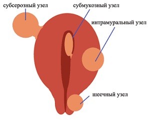 Міома матки причини, симптоми і методи лікування