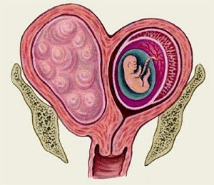 Miomul cauzat de uter, simptome și metode de tratament