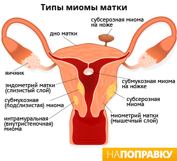 Myoma de simptome și semne uterine, tratament - expediere