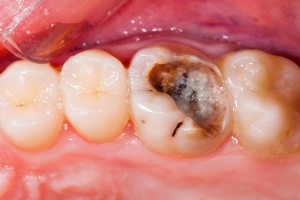 Poate durerea urechii de pe dinte la o parte după îndepărtarea sau tratamentul?