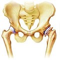 Este posibil să se vindece osteocondroza uneori?