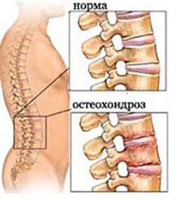 Este posibil să se vindece osteocondroza uneori?