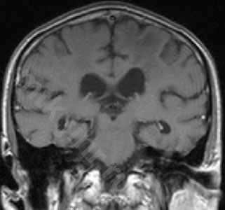 Mtk - метастази в головний мозок