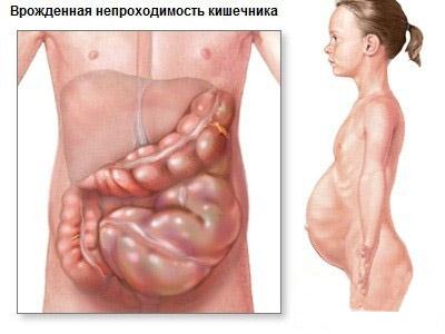 Непрохідність кишечника симптоми, лікування, народні засоби - my life