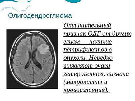 Олігодендроцітома головного мозку анапластична і високодиференційована лікування, скільки живуть