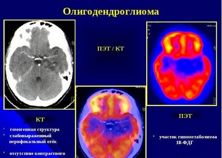 Oligodendrocitomul creierului anaplazic și tratamentul foarte diferențiat, câte persoane trăiesc