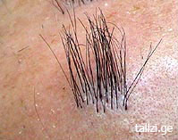 Despre clinica noastră, clinica talizi (transplant de păr) Despre clinica noastră, clinica talizi