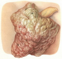 Tumorile scrotului - cauze, simptome, diagnostic și tratament