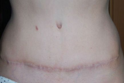 Complicațiile după abdominoplastie pot fi foarte diferite, de la edeme mici și până la