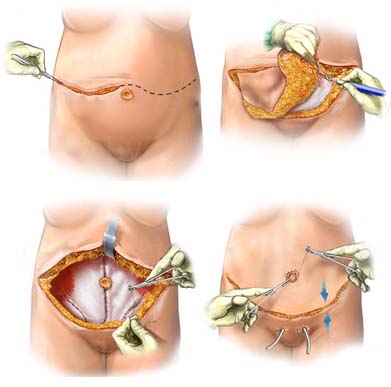 Complicațiile după abdominoplastie pot fi foarte diferite, de la edeme mici și până la