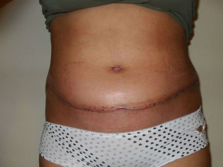 Complicațiile după abdominoplastie pot fi foarte diferite, de la edeme mici și până la