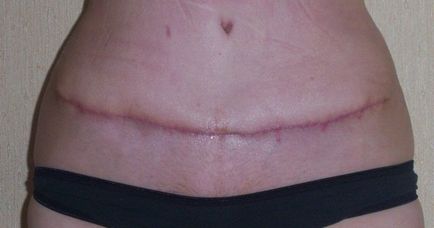 Complicații după abdominoplastie (plastic abdominal) - fotografie, recenzii