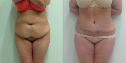 Complicații după abdominoplastie (plastic abdominal) - fotografie, recenzii