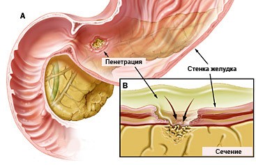 Complicații ale penetrării ulcerului gastric, sângerare, perforare