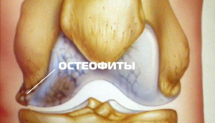 a térd osteophytes kezelésére emberek jogorvoslatok