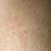 Pitiriazis sau lichen multicolor la oameni tratați cu agenți antifungici