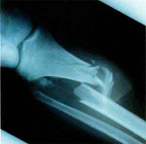 Törés röntgen - fénykép 24236-5