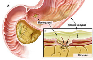 Перфорація виразки шлунка чи можна померти